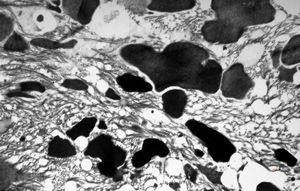 F,53y. | ochronosis … black aortal valve